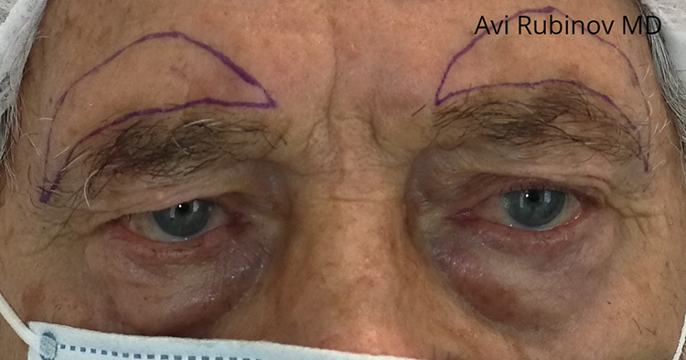 Bilateral brow lift before