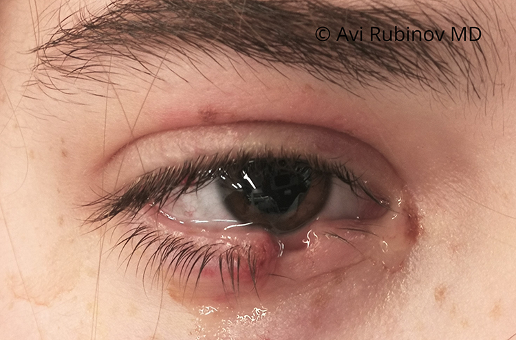 Eyelid laceration repair before