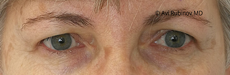 Removal of excess upper eyelid skin before