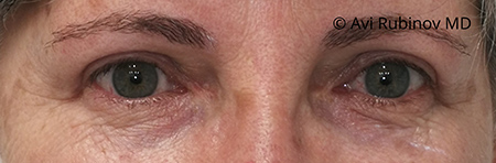 Removal of excess upper eyelid skin after
