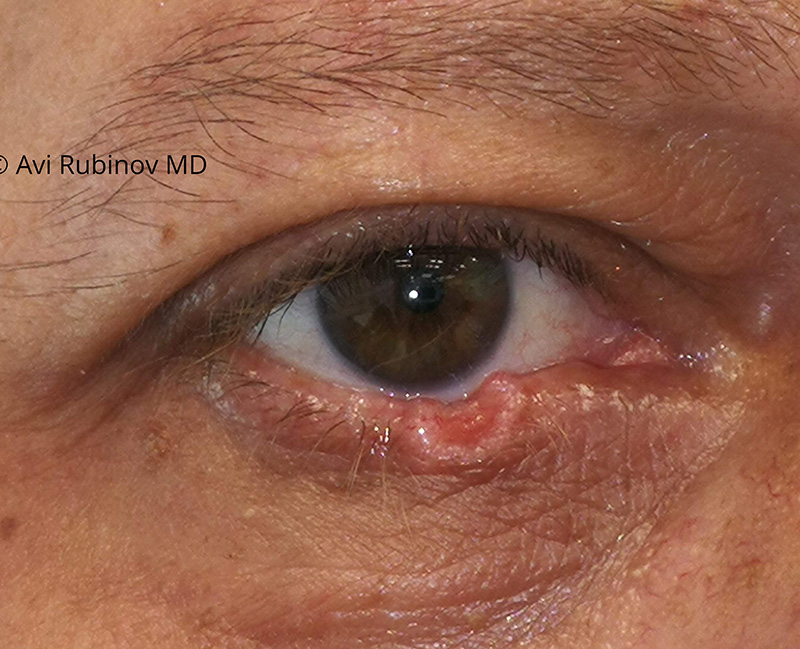 Removal of eyelid tumor and reconstruction before
