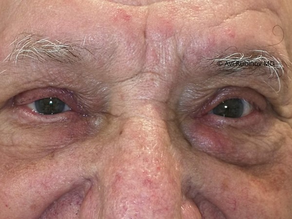 Repair of droopy eyelids and removal of excess upper eyelid skin and fat 