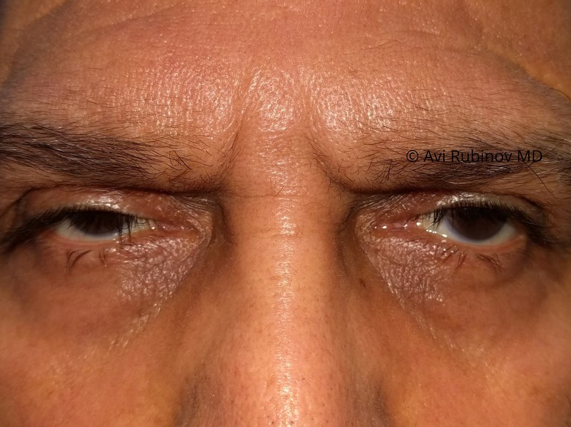 ptosis before