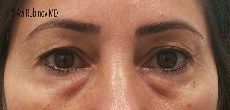 uper and lower blepharoplasty before