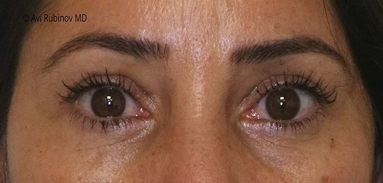 uper and lower blepharoplasty after