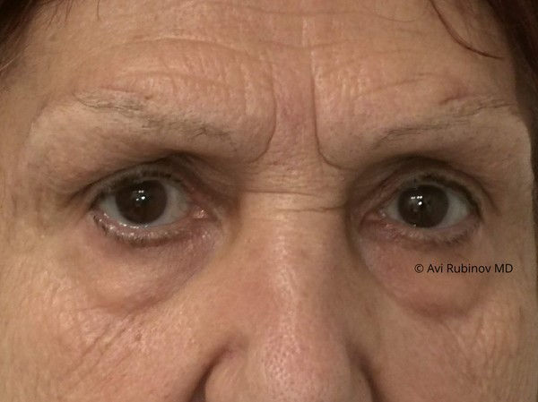 Bilateral brow lift ניתוח