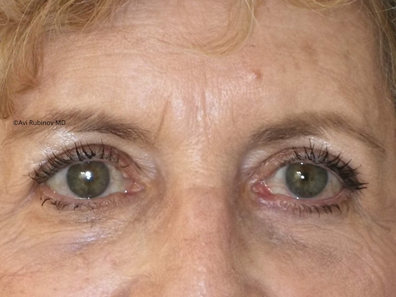 upper eyelids after