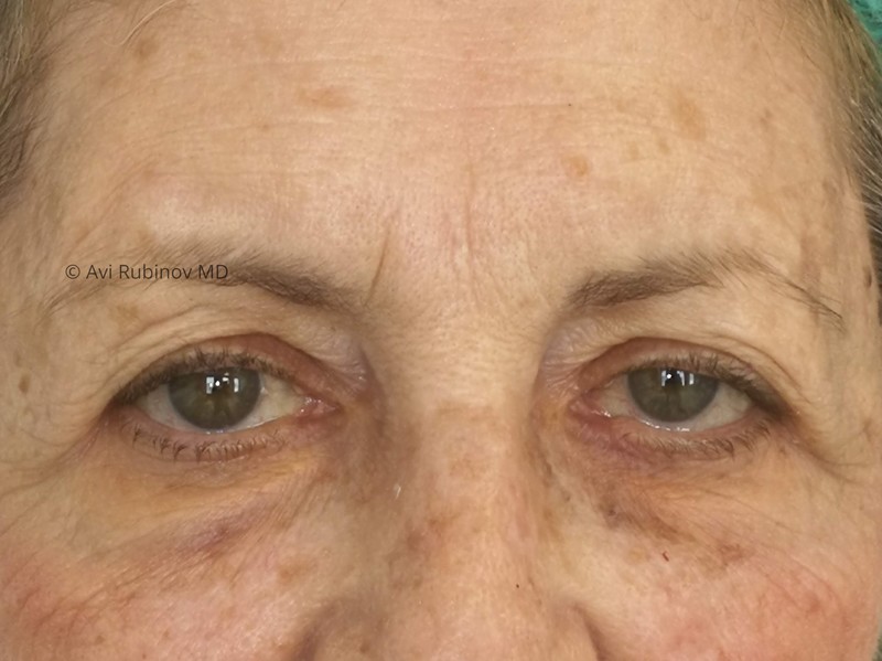 upper eyelids before